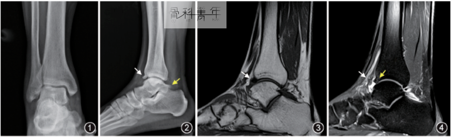 5大踝关节撞击综合征的解剖因素、影像表现、诊断与治疗