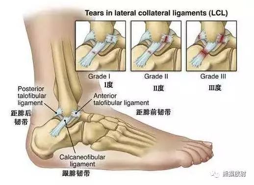 踝关节的韧带解剖及损伤表现