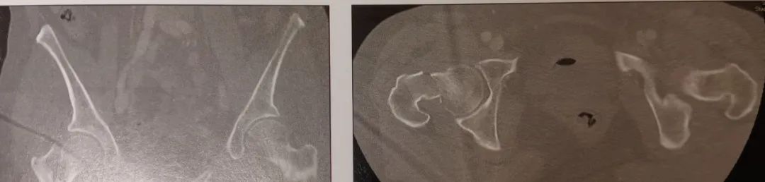 股骨颈骨折切开复位内固定的手术技巧