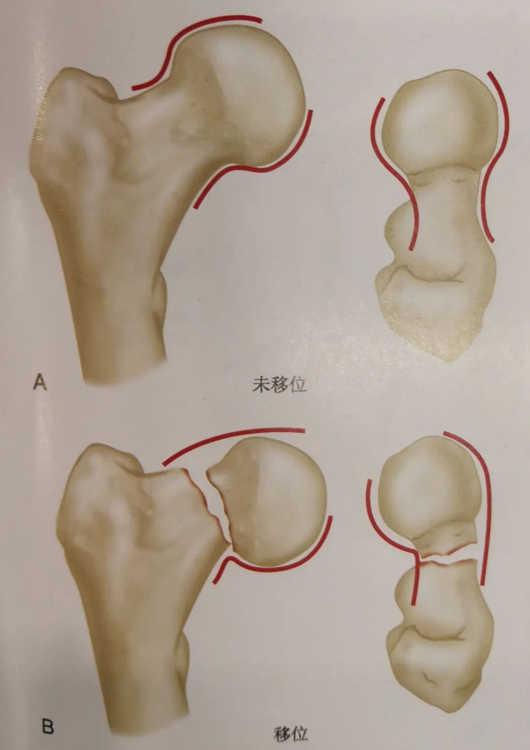 股骨颈骨折切开复位内固定的手术技巧