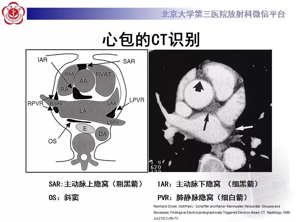 心包窦及心包隐窝的解剖结构（内附CT断层图解）