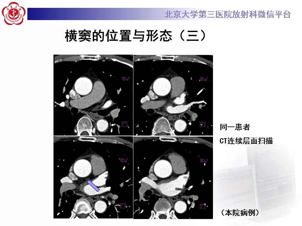 心包窦及心包隐窝的解剖结构（内附CT断层图解）