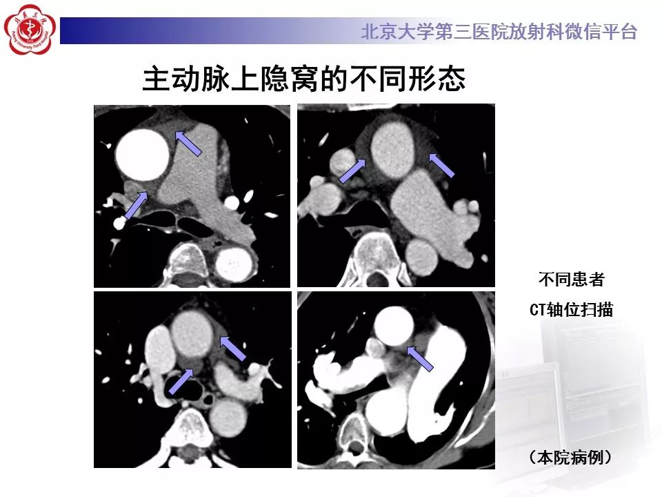 心包窦及心包隐窝的解剖结构（内附CT断层图解）