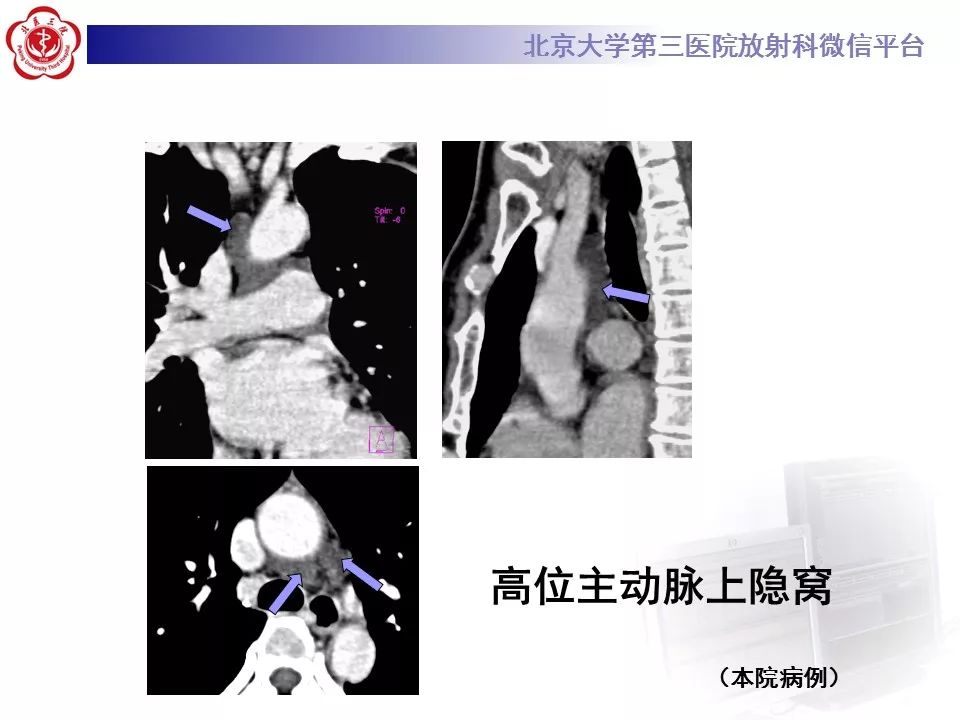 心包窦及心包隐窝的解剖结构（内附CT断层图解）