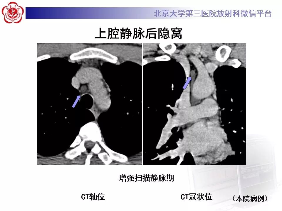 心包窦及心包隐窝的解剖结构（内附CT断层图解）