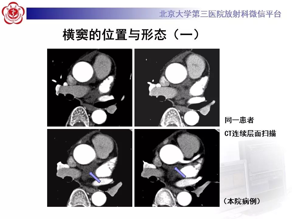 心包窦及心包隐窝的解剖结构（内附CT断层图解）