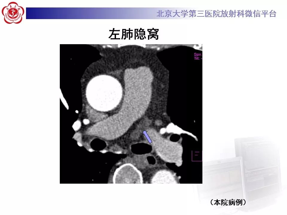 心包窦及心包隐窝的解剖结构（内附CT断层图解）