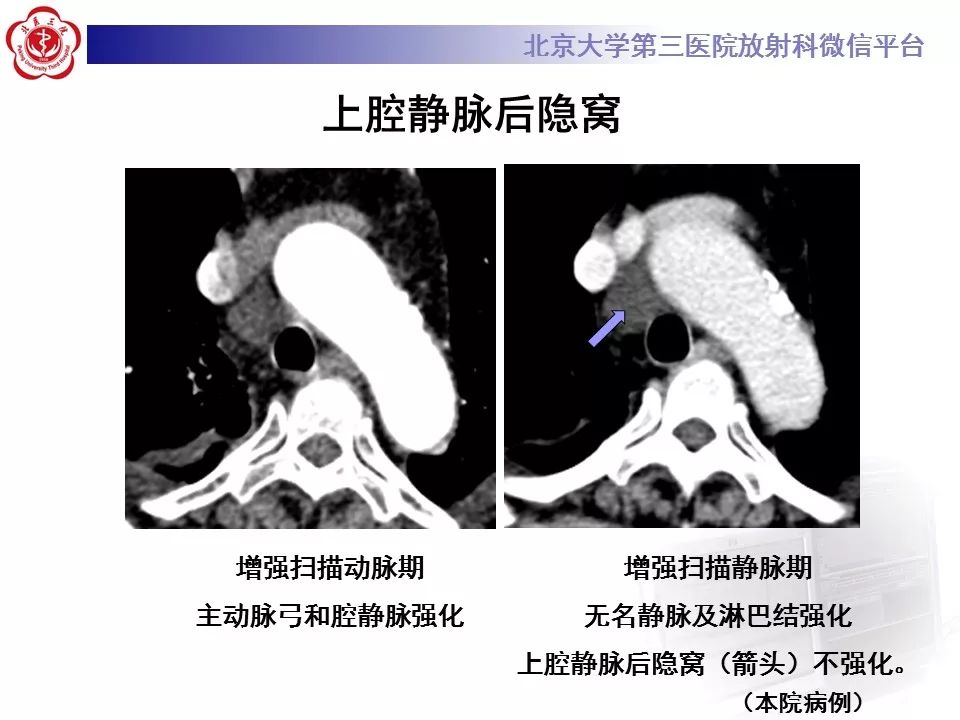 心包窦及心包隐窝的解剖结构（内附CT断层图解）