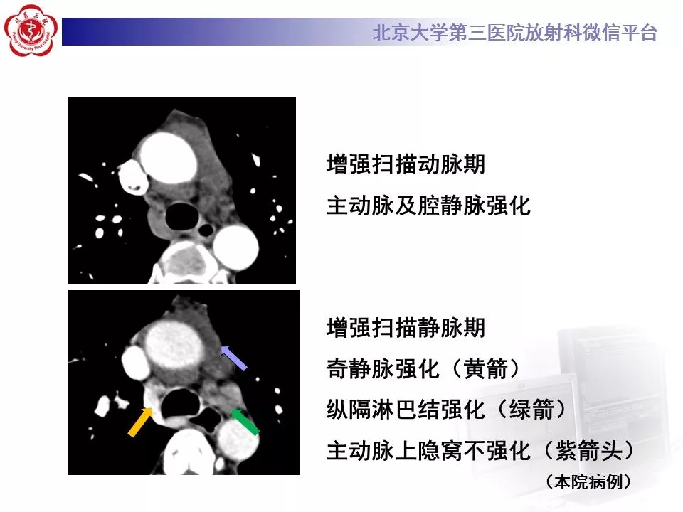 心包窦及心包隐窝的解剖结构（内附CT断层图解）