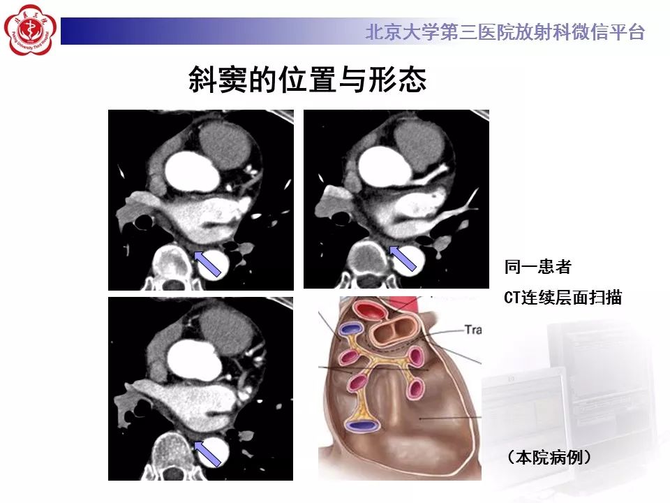 心包窦及心包隐窝的解剖结构（内附CT断层图解）