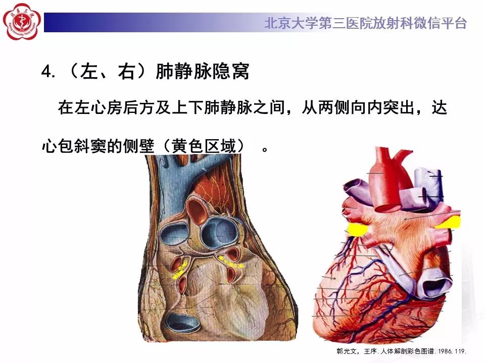 心包窦及心包隐窝的解剖结构（内附CT断层图解）