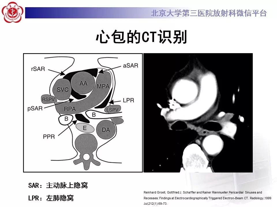 心包窦及心包隐窝的解剖结构（内附CT断层图解）