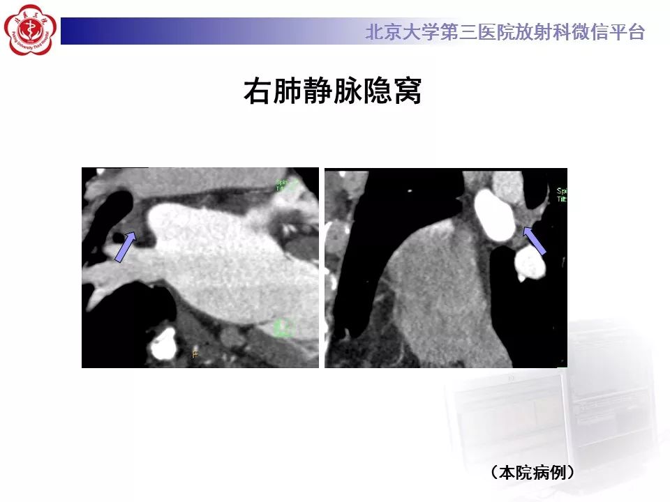 心包窦及心包隐窝的解剖结构（内附CT断层图解）