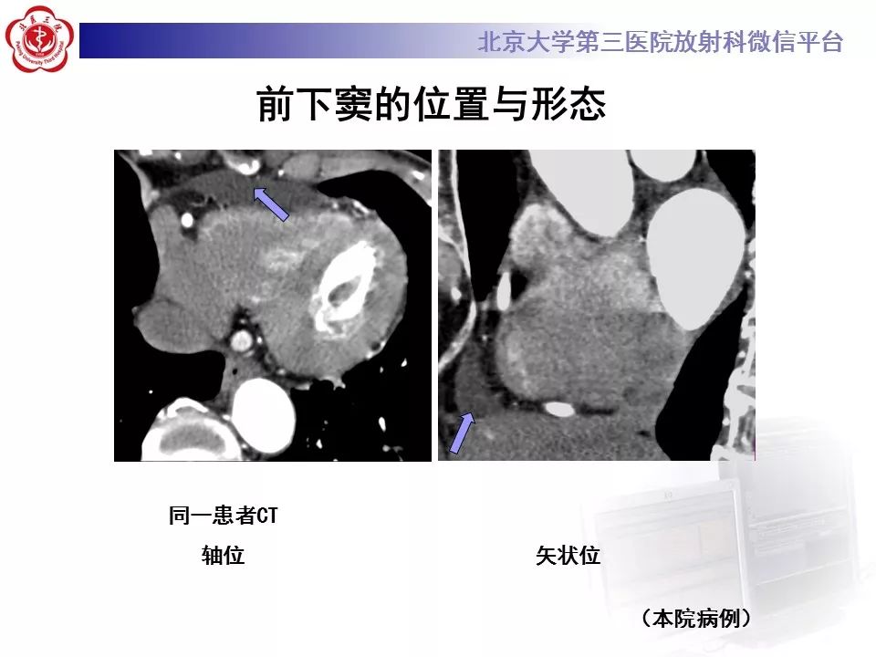 心包窦及心包隐窝的解剖结构（内附CT断层图解）