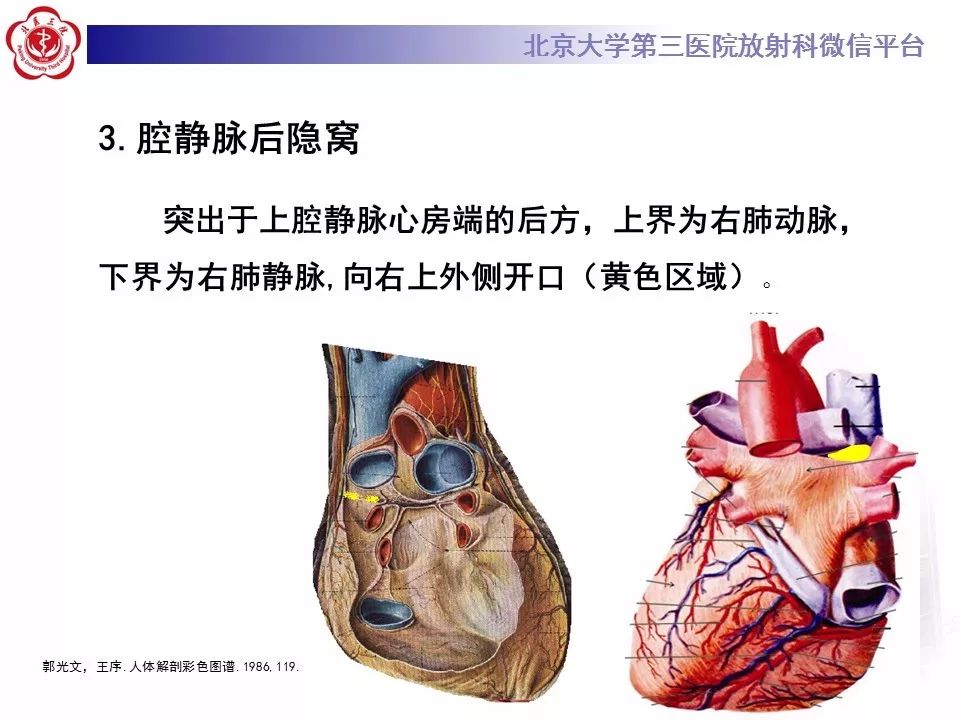 心包窦及心包隐窝的解剖结构（内附CT断层图解）