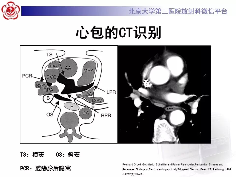 心包窦及心包隐窝的解剖结构（内附CT断层图解）