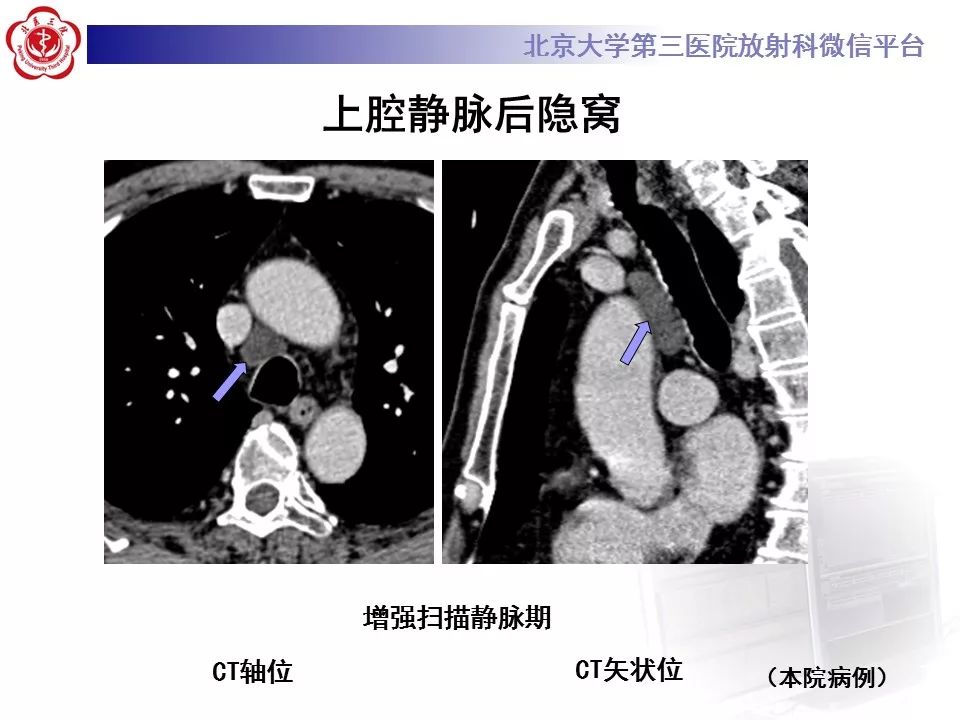 心包窦及心包隐窝的解剖结构（内附CT断层图解）