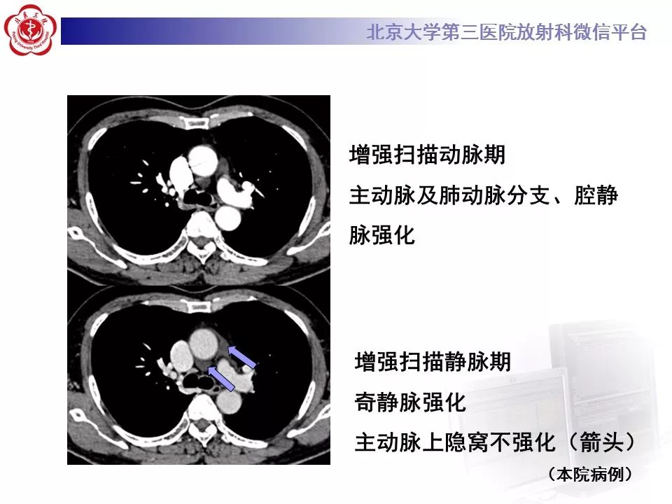 心包窦及心包隐窝的解剖结构（内附CT断层图解）