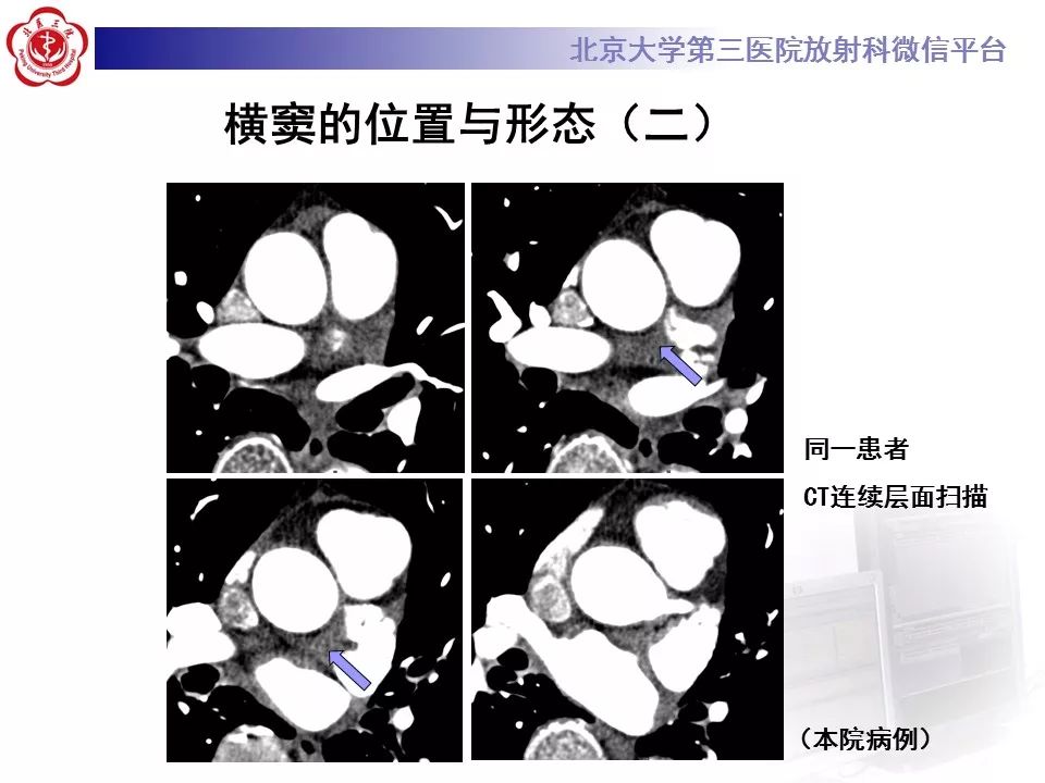 心包窦及心包隐窝的解剖结构（内附CT断层图解）