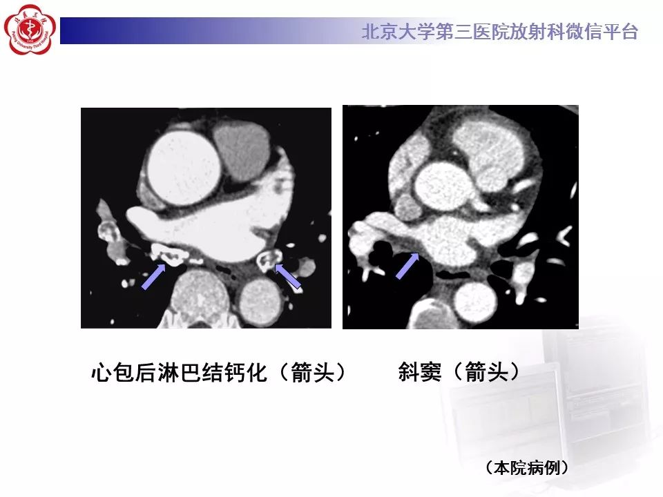 心包窦及心包隐窝的解剖结构（内附CT断层图解）