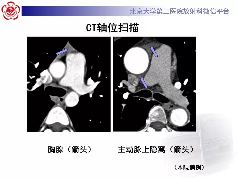 心包窦及心包隐窝的解剖结构（内附CT断层图解）