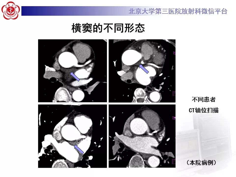 心包窦及心包隐窝的解剖结构（内附CT断层图解）