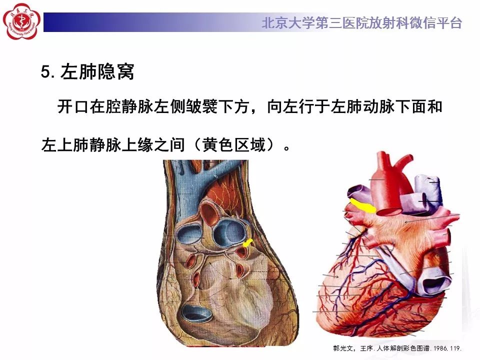 心包窦及心包隐窝的解剖结构（内附CT断层图解）