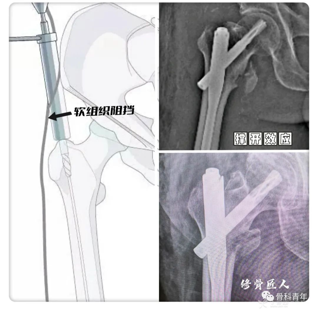 实战经验：髓内钉固定治疗股骨转子间骨折10条推荐（上篇