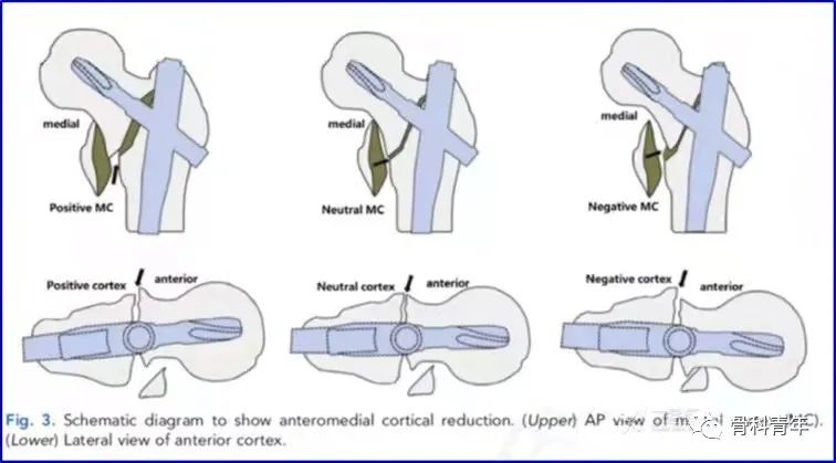 实战经验：髓内钉固定治疗股骨转子间骨折10条推荐（上篇