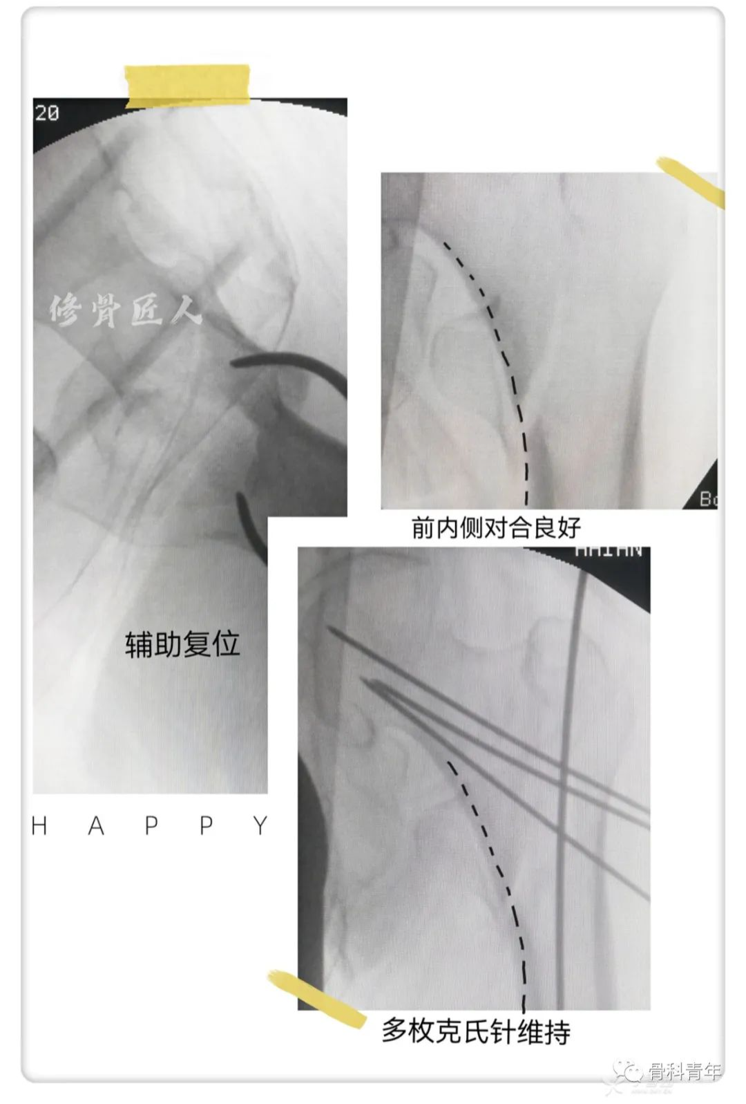 实战经验：髓内钉固定治疗股骨转子间骨折10条推荐（上篇