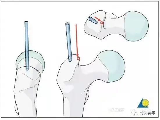 实战经验：髓内钉固定治疗股骨转子间骨折10条推荐（上篇