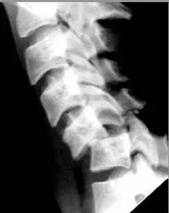 高手总结的颈椎十类骨外伤X片，看一遍秒掌握