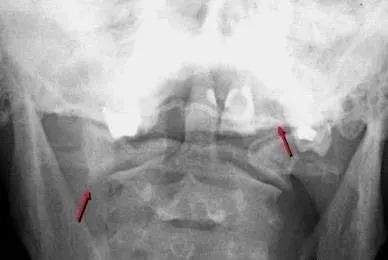 高手总结的颈椎十类骨外伤X片，看一遍秒掌握