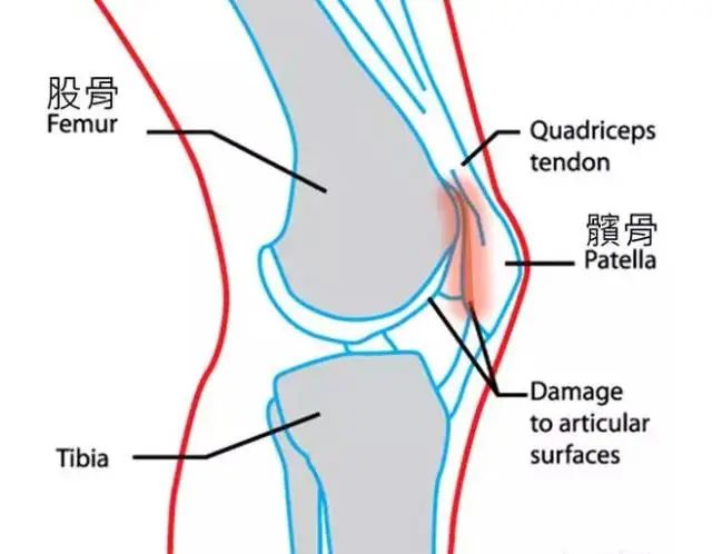 膝盖周边痛！膝关节疼痛一般是什么病？