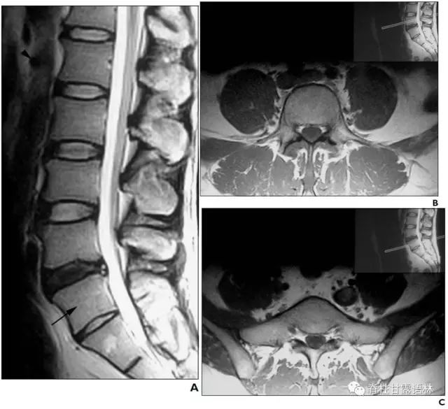 10种脊柱畸形影像表现汇总