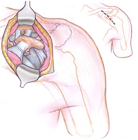 最全喙突骨折的解剖与手术技巧详解，值得一读！