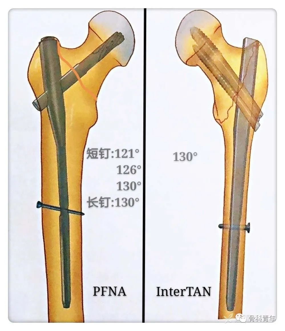 实战经验:髓内钉固定治疗股骨转子间骨折10条推荐(中篇 4
