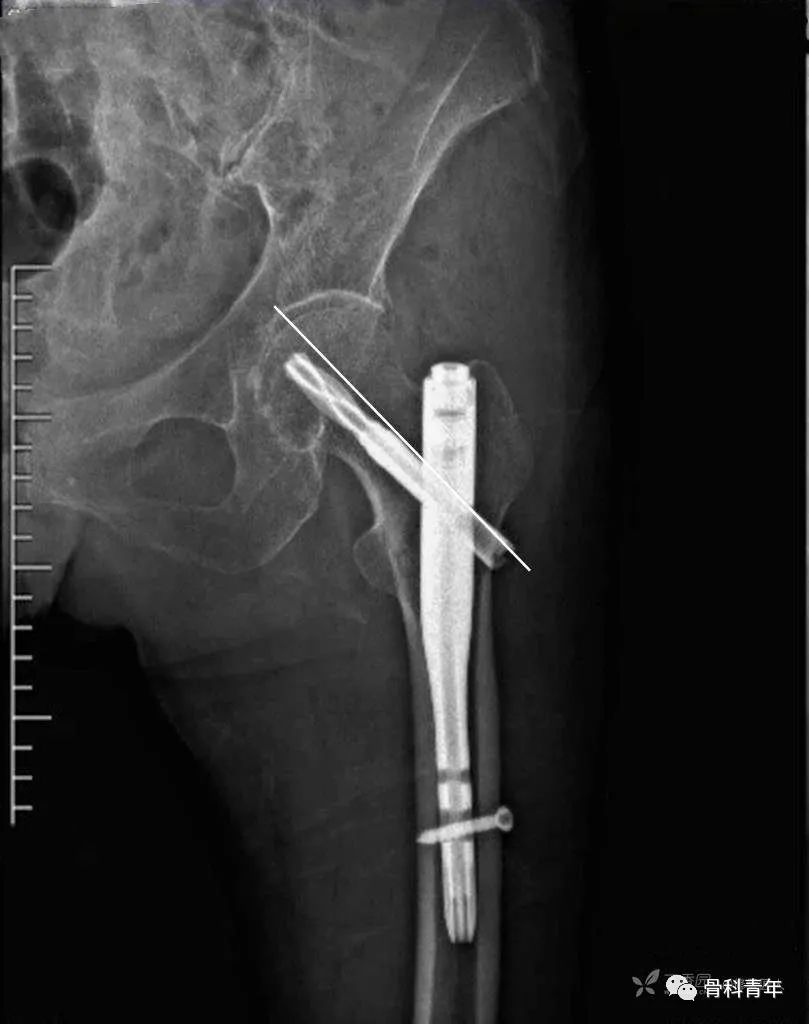 实战经验：髓内钉固定治疗股骨转子间骨折10条推荐（中篇