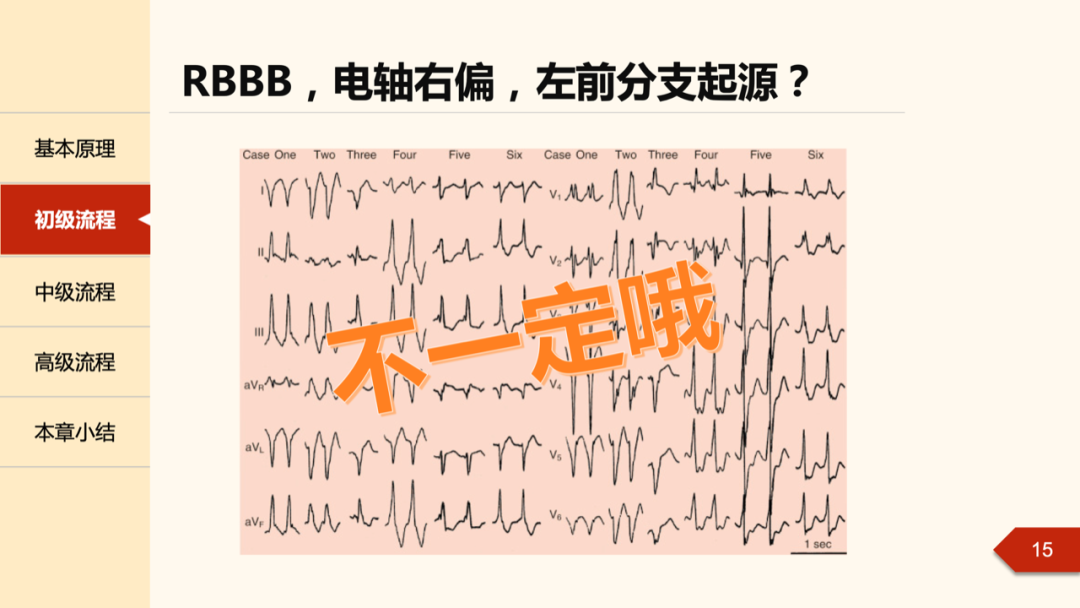 室性早搏，如何进行体表心电图定位？