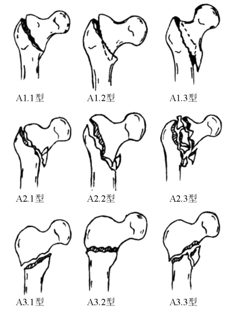 股骨转子间骨折常见分型