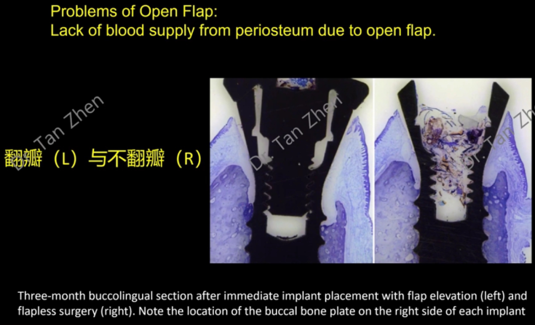 不可忽视的角色——即刻种植中软组织移植的应用①