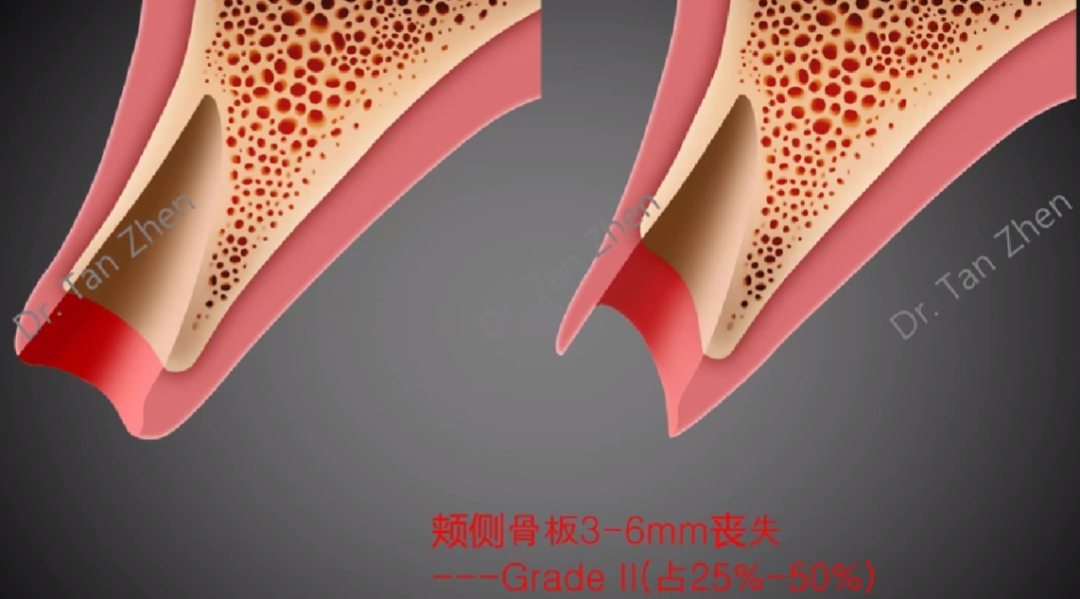 不可忽视的角色——即刻种植中软组织移植的应用①