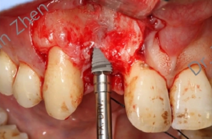 不可忽视的角色——即刻种植中软组织移植的应用①
