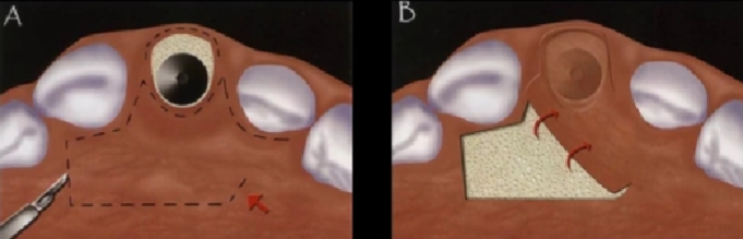 不可忽视的角色——即刻种植中软组织移植的应用①