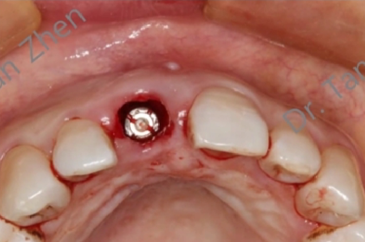 不可忽视的角色——即刻种植中软组织移植的应用①