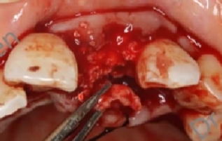 不可忽视的角色——即刻种植中软组织移植的应用①