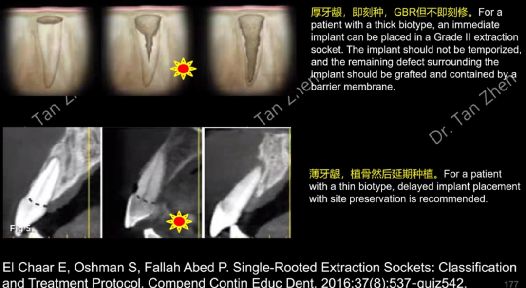 不可忽视的角色——即刻种植中软组织移植的应用①