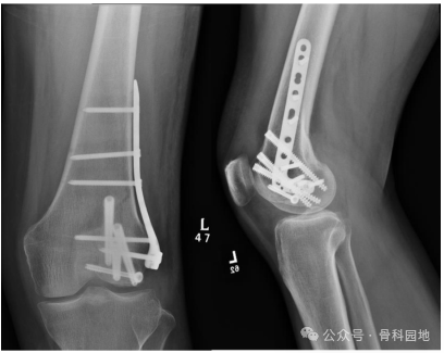 手术技巧｜巧用胫骨近端外侧板加空心螺钉治疗Hoffa骨折