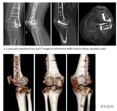 手术技巧｜巧用胫骨近端外侧板加空心螺钉治疗Hoffa骨折