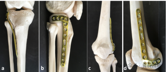 手术技巧｜巧用胫骨近端外侧板加空心螺钉治疗Hoffa骨折